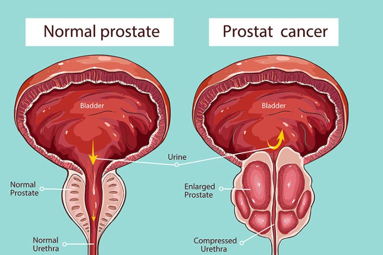 Normal prostate and acute prostatitis. Medical illustration
